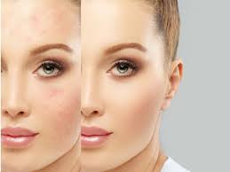 Kulit wajah yang mengelupas biasanya disebabkan oleh kondisi kulit kering. Beauty Journal Situs Kecantikan Dan Gaya Hidup Andalan Wanita Masa Kini