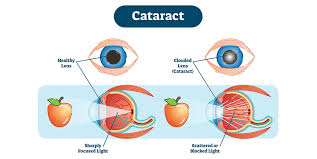 Image result for Cataract Extraction