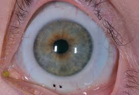Check spelling or type a new query. Coding For Medically Necessary Contact Lenses