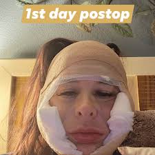 Do i do deep plane neck lift or mini lift ,44years old ?