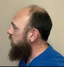 2 Transplant, 8 ay arayla. Şu anda 2. transplant sonrası 10. gündeyim :  r/HairTransplants