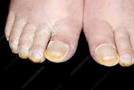 Image result for Clubbing nails feet