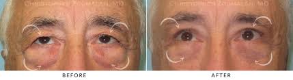 Oriental upper eyelid surgery, or asian double eyelid surgery or oriental. Male Brow Lift Before And After Photo Gallery