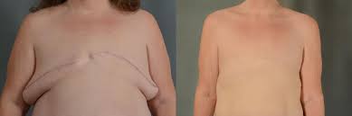 Image result for Mastectomy