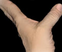 Sprained Thumb - Orthoinfo - Aaos