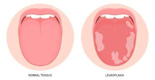 Image result for cancer tongue symptoms)