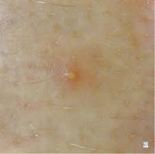 Global Dermatology التهاب الجريبات الدمامل البثور الجمرات