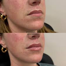 cyst be gone (🫡for now🫡) incision and drainage of a cyst is great for a  quick treatment but by not removing the entirety of the cyst wall poses  risk of recurrence