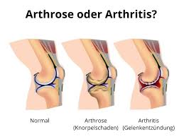 L'arthrose ou ostéoarthrite se manifeste par des douleurs aux niveau des articulations causées par l'usure du cartilage et de on fait le point sur les symptômes et les traitements de l'arthrose. Was Ist Der Unterschied Zwischen Arthrose Und Arthritis