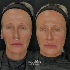 Sapphire Medical Aesthetics