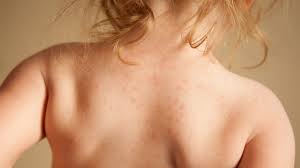 Rarely, a rash and soreness can be signs of inflammatory breast cancer, a form of the disease that can grow quickly, often in weeks or months. Food Allergy Symptoms Faq How To Tell If Your Kid Has A Food Allergy