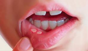 mouth ulcer - Symptoms,risks and natural remedy