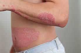 Autoimmune Diseases That Can Be Fatal Patient Advice Us News