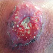 Image result for carbuncle