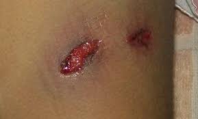 The morbidity of the wound relates to the tissue through which the bullet passes. Gunshot Injuries In Forensic Medicine Blog Of Dr Agnibho