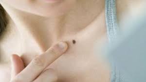 Bagi siapa saja yang tidak menyukai tahi lalat bisa dihilangkan dengan mudah. Cara Efektif Hilangkan Tahi Lalat Awas Jangan Lakukan Sendiri