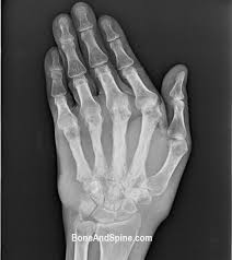 Image result for Osteomyelitis XRay