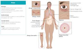 The symptoms affect many parts of the body. Hypersensitivity Reactions Amboss