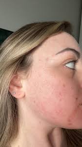 i've been scared to post but whatever here goes nothing. i have acne prone  oily skin, im currently