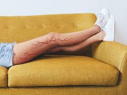 Spider Veins and Varicose Veins ...