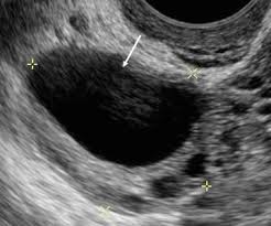 However, its views may be limited by abdominal structures such as bowel gas. Ovary And Adnexa Imaging Techniques Anatomy And Normal Findings Springerlink