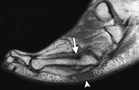 Maybe you would like to learn more about one of these? Mr Imaging Of Entrapment Neuropathies Of The Lower Extremity Radiographics