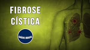 A fibrose cística (fc) ou fibrose quística é uma doença genética que afeta principalmente os pulmões, mas também o pâncreas, fígado, rins e intestino. Fibrose Cistica Serie Saude Brasil Youtube
