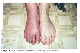 An Overview Of Complex Regional Pain Syndrome And Its Management
