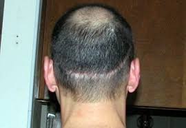 3.9 out of 5 stars. Concealers Hair Loss Forum Hair Transplant Forums