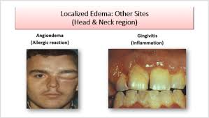 Image result for Localized Edema
