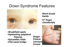 Brush Field Spots White Or Grey Spot In The Periphery Of The Iris Medical Knowledge Epicanthic Fold Down Syndrome Features