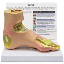 Image result for gout