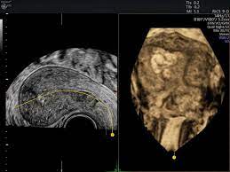 Ultrasound at high intensity near bony areas can be detrimental to the periosteum because of high. How Retained Products Of Conception Can Impact Fertility Empowered Women S Health