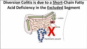 51 year old woman with crohn's disease and microcarcinoids associated with diversion colitis (j crohns colitis 2008;2:246). Imran Uraizee Md On Twitter Diversion Colitis 2 2 Short Chain Fatty Acid Deficiency In The Surgically Excluded Segment Gipath Virtualpathgr Pathboards Https T Co Nztwwihv6o