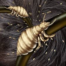 Image result for head lice