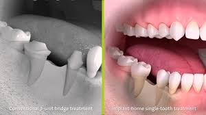 Dental bridges, also called tooth bridges, are placed when patients have one or more teeth missing or have gaps between their teeth. Dental Bridge Cost Estimate Types And Pros And Cons