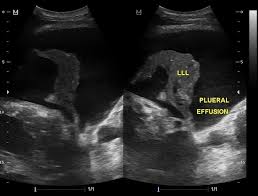 Large effusions will extend to the other points too. Cardiomegaly With Bilateral Pleural Effusion Radiology Case Radiopaedia Org