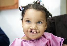 Definición de solfa syllable enfermedad. Sonrisas Labio Leporino Y Paladar Hendido Labio Leporino Salud Dental Leporino