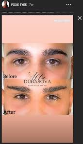 Lower eyelid surgery in turkey is performed under general anesthesia in contrary to upper eyelid surgery as it is more complicated. Before After Fox Eye Surgery On Male In Turkey From Nct To Pct Good Or Bad Results Pics Looksmax Me Men S Self Improvement Aesthetics