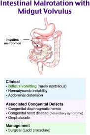 Image result for Midgut Volvulus