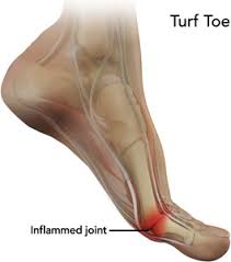Artificial turf has become more common than real grass on many football fields because it's much. Turf Toe Pain Treatment Penrith Turf Toe Injury Blue Mountains Blacktown