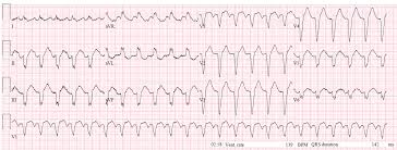 Dr Smith S Ecg Blog Test Almost All Of Your Most Important Ecg Rhythm Interpretation Skills With This Case