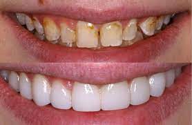 Veneers can fix severe discoloration. Veneers Houston Best Dental In Tx Porcelain Veneers In Texas