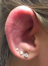 How do you heal swollen pierced ears? Medical Mystery A Teen S Ear Piercing Goes Awry