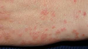 Image result for scabies bite