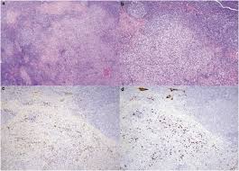Light palpation of the abdomen. Histopathological Findings In 29 Lymph Node Biopsies With Increased Igg4 Plasma Cells Modern Pathology