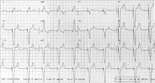 The ecg clearly shows the presence of an av pacemaker. Twelve Leads Ecg After Vvi Type Permanent Pacemaker Implantation Download Scientific Diagram