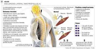 A als, o esclerosis lateral amiotrófica, es una enfermedad de las partes del sistema nervioso que controlan el movimiento de los músculos voluntarios. Inicio Esclerosis Lateral Amiotrofica Compendio De Informacion