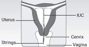 International university college of turin, a university located in torino, italy. Intrauterine Contraception Iuc Iud Ius