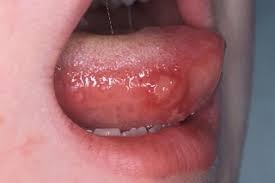 Image result for Hand foot and mouth disease HFMD roof of mouth
